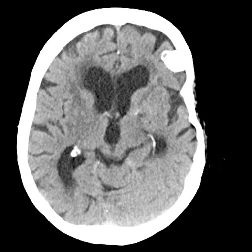 Aufnahme Gehirn-CT
