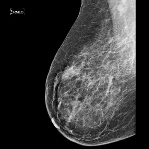 Mammographie - Röntgenaufnahme der Brust