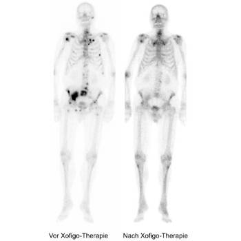 Xofigo-Therapie: Knochenmetastasen vorher/nachher