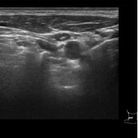 Ultraschall der Lymphknoten